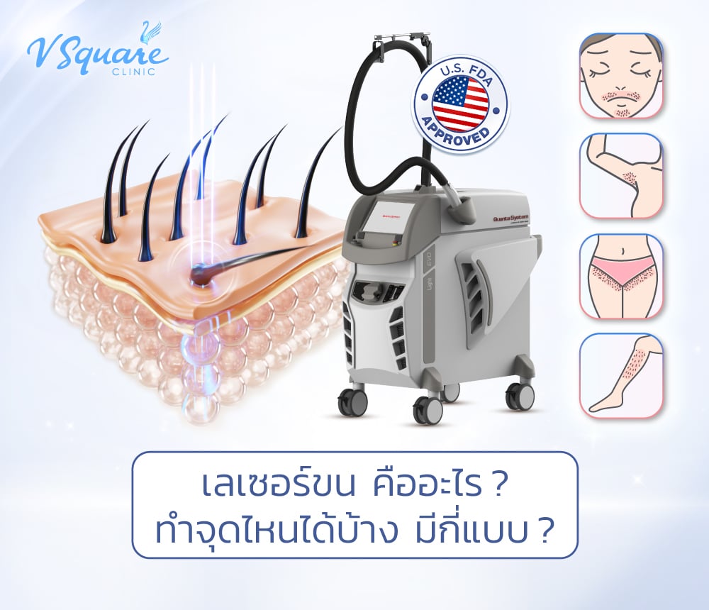 เลเซอร์ขน