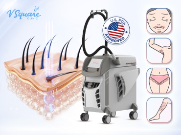 เลเซอร์ขน 370x277