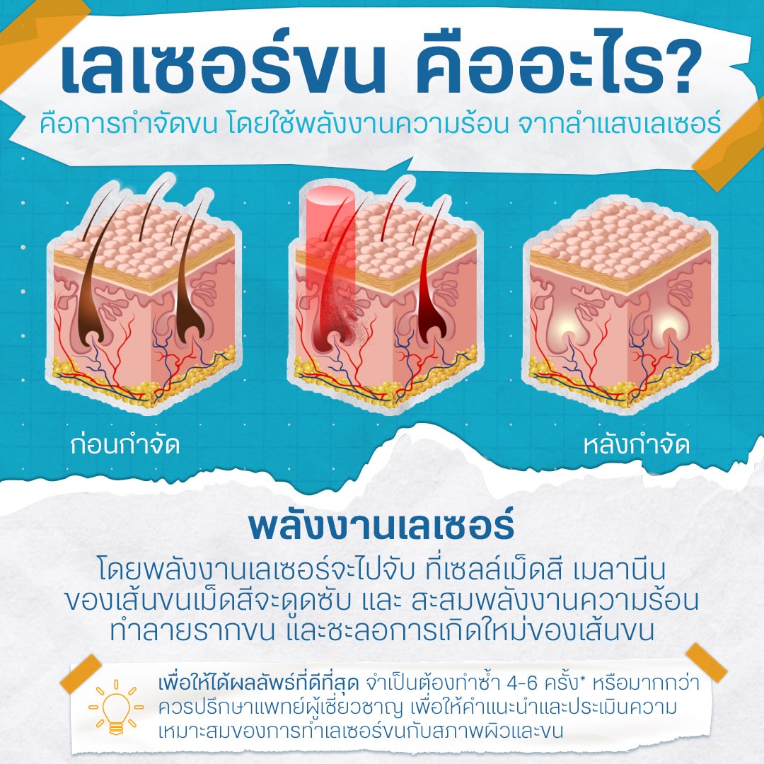 เลเซอร์ขน คืออะไร