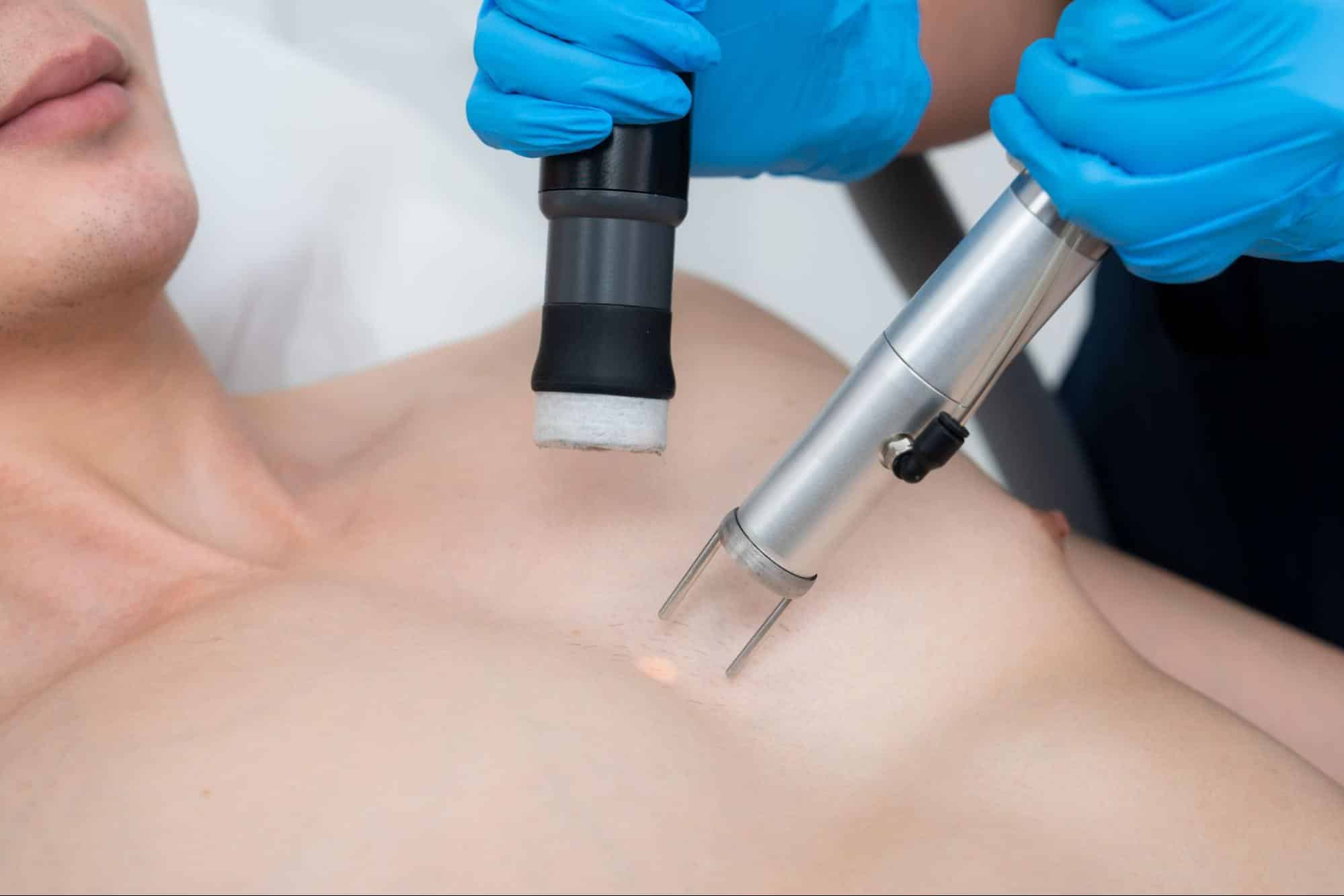 เลเซอร์ขนหน้าอก คือ