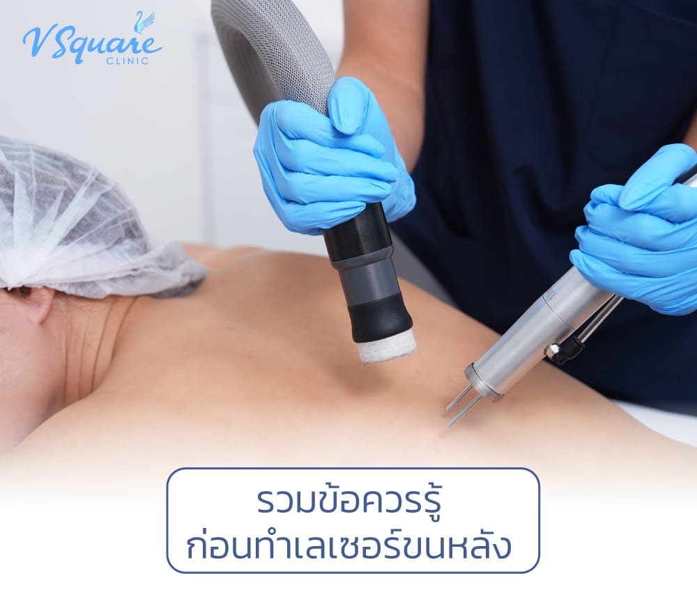 เลเซอร์ขนหลัง