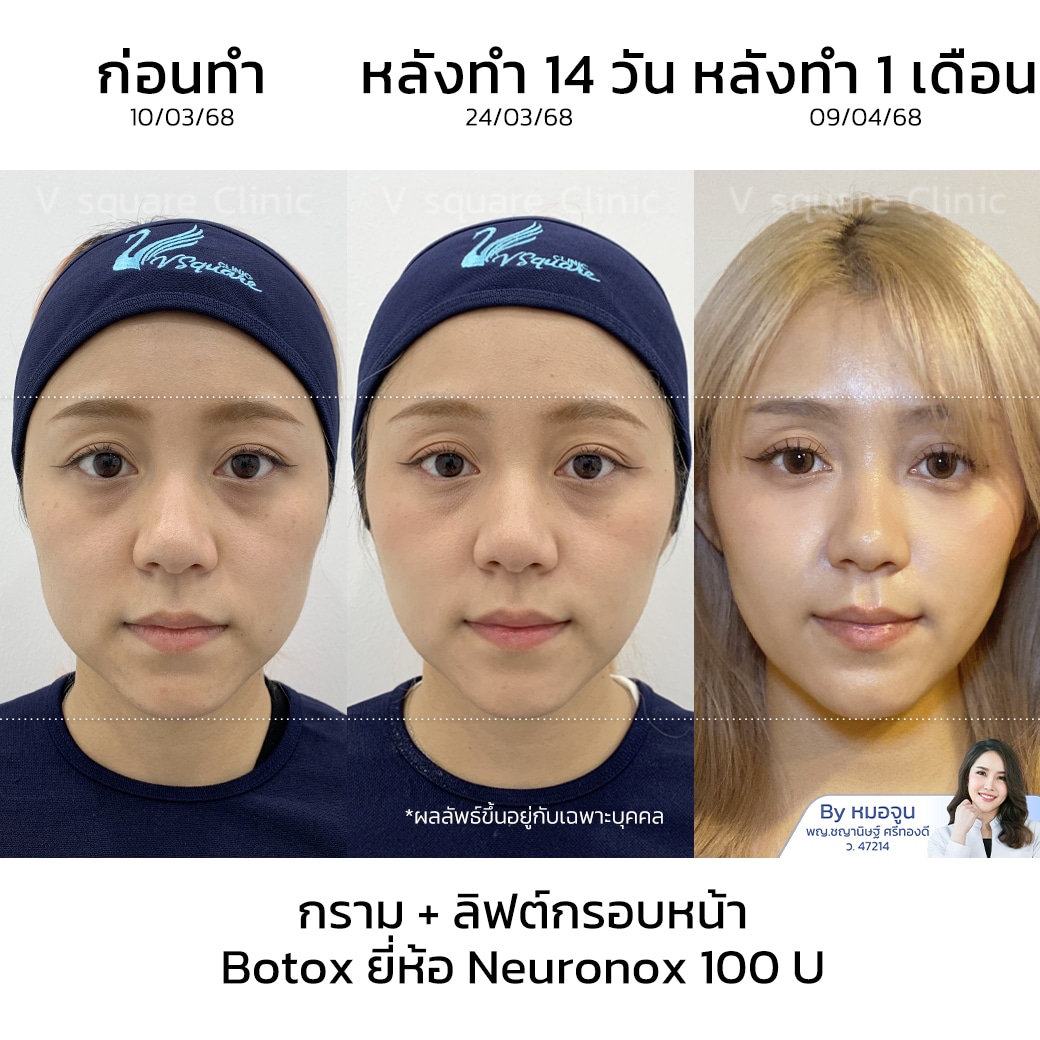 ฉีดโบท็อกลดกราม รีวิว_คุณดอลลาร์