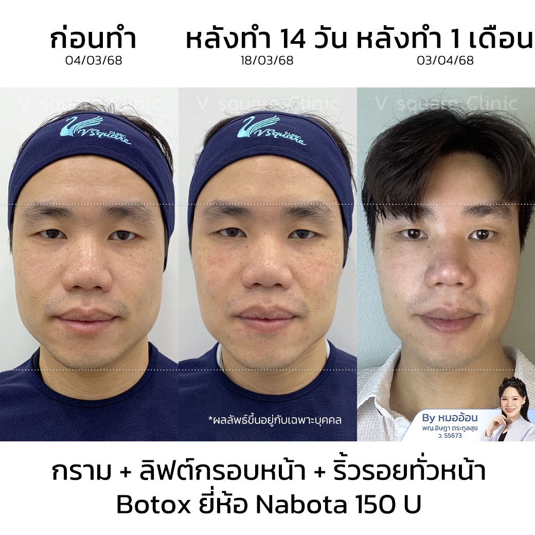 ฉีดโบท็อกลดกราม รีวิว_คุณเต้