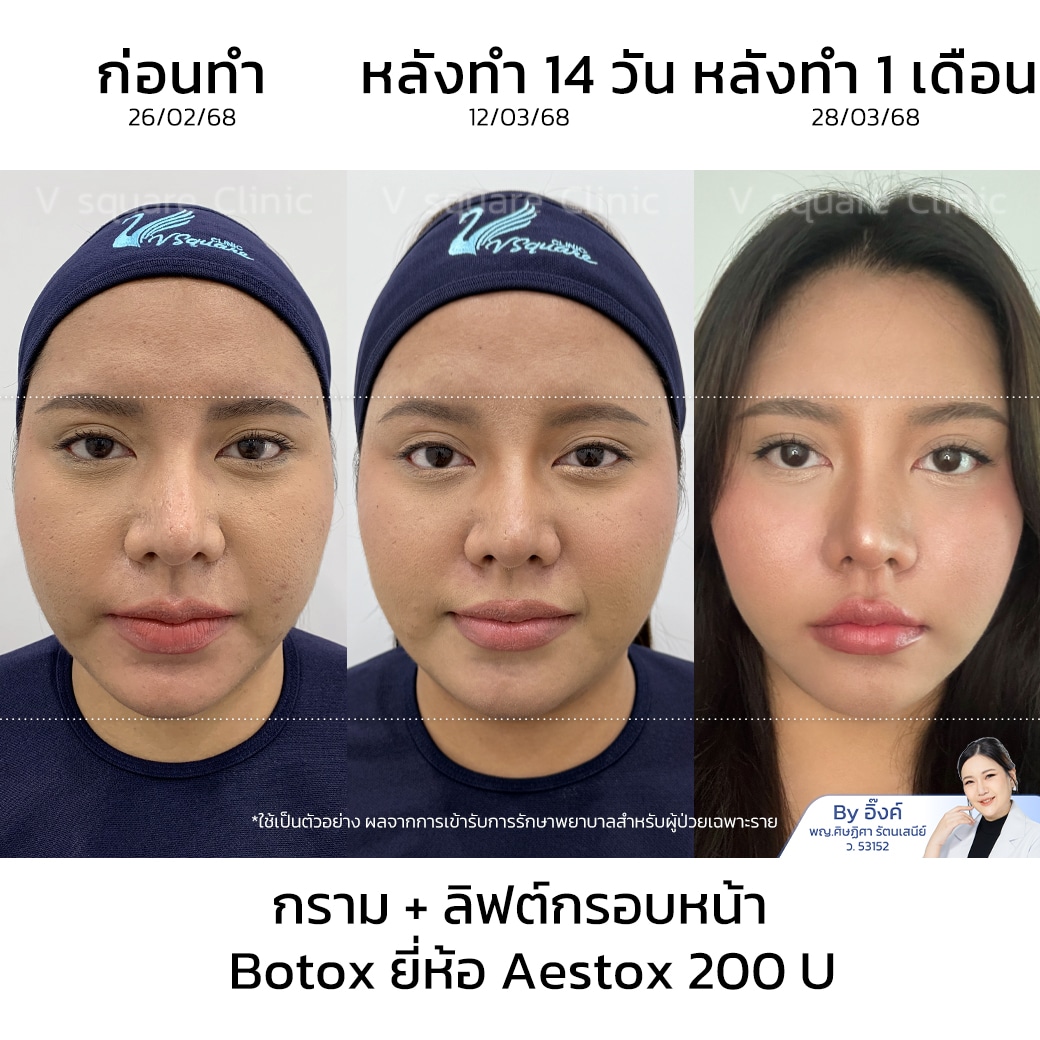 รีวิวฉีดโบท็อกหน้าเรียว_น้องแพม