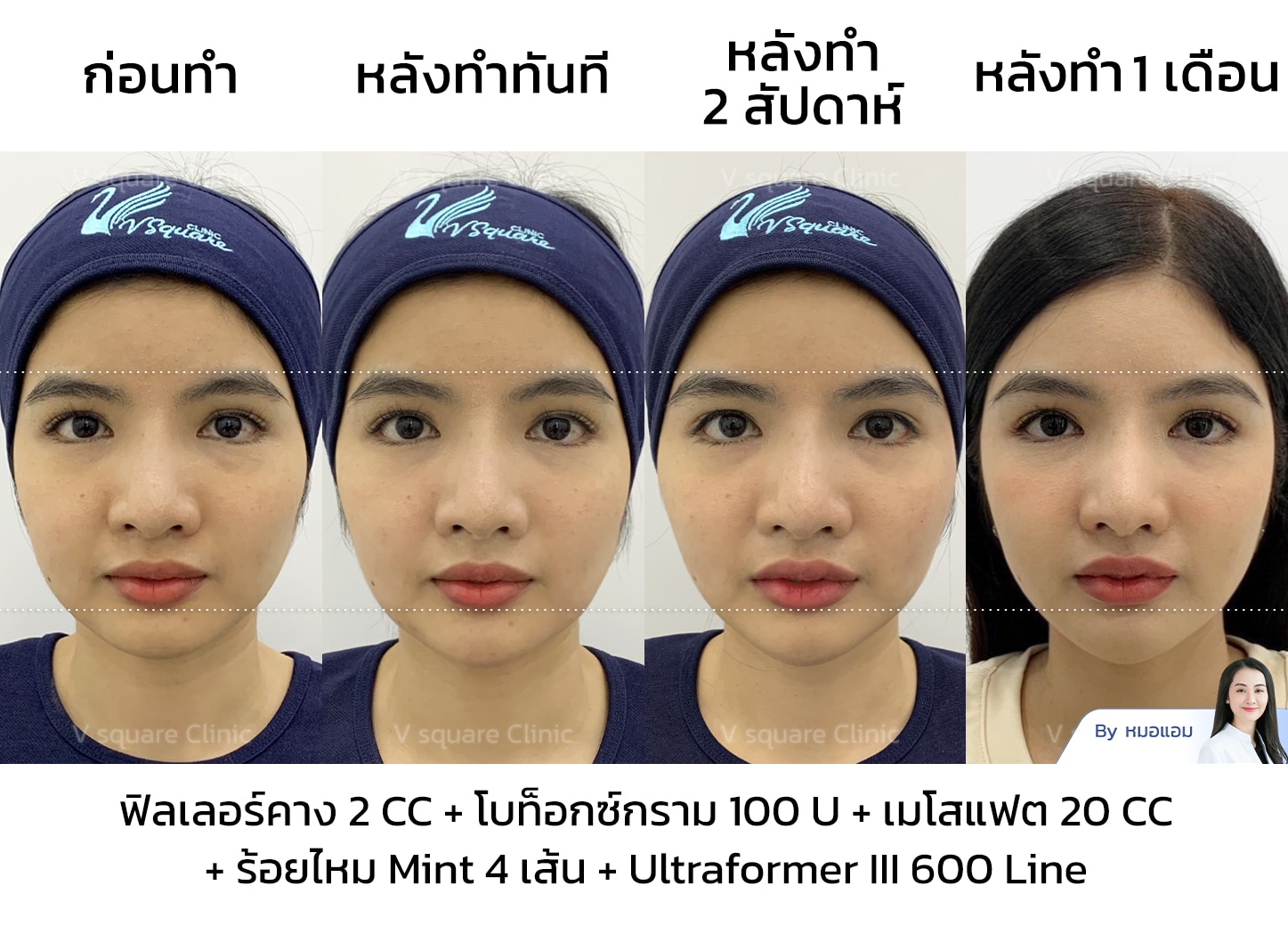 รีวิวโบท็อกกรามหน้าเรียว_คุณซานตี้ Influencer (คอนเทนต์หน้าเรียว)