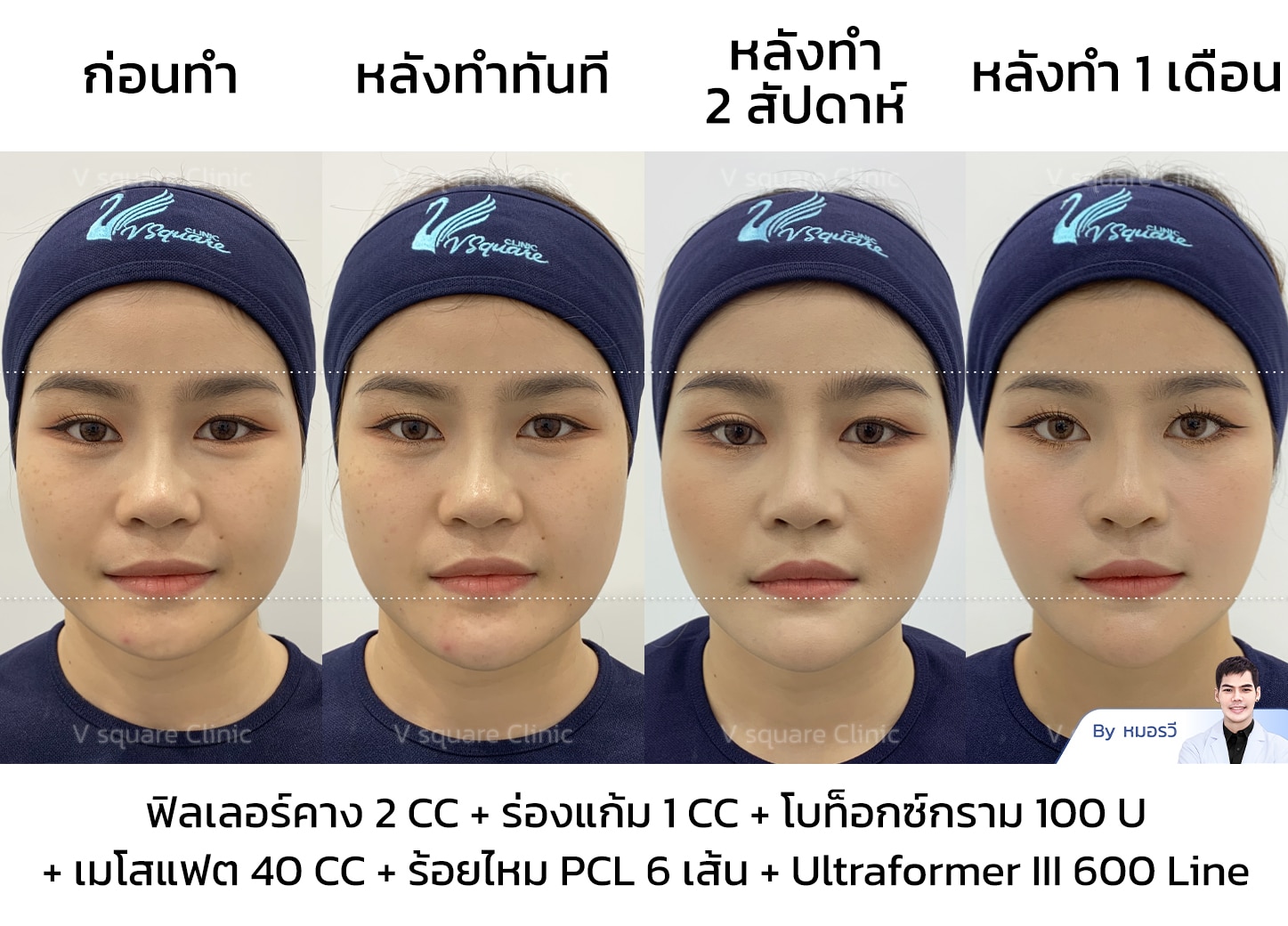 รีวิวโบท็อกกรามหน้าเรียว_คุณหญิง Influencer (คอนเทนต์หน้าเรียว)