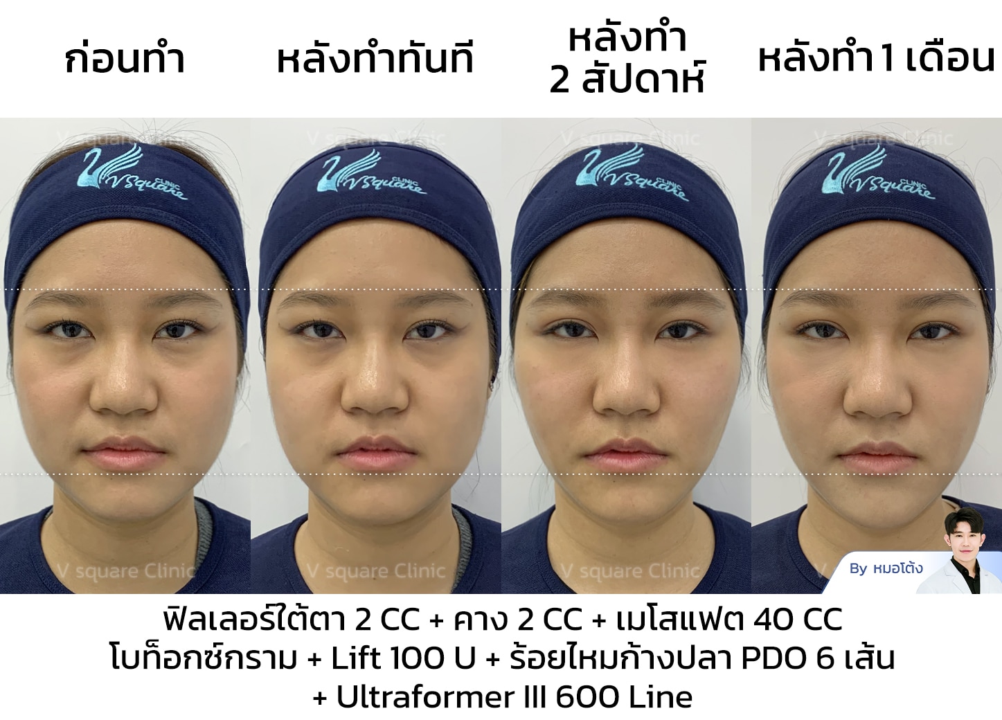 รีวิวโบท็อกกรามหน้าเรียว_แจน Influencer (คอนเทนต์หน้าเรียว)