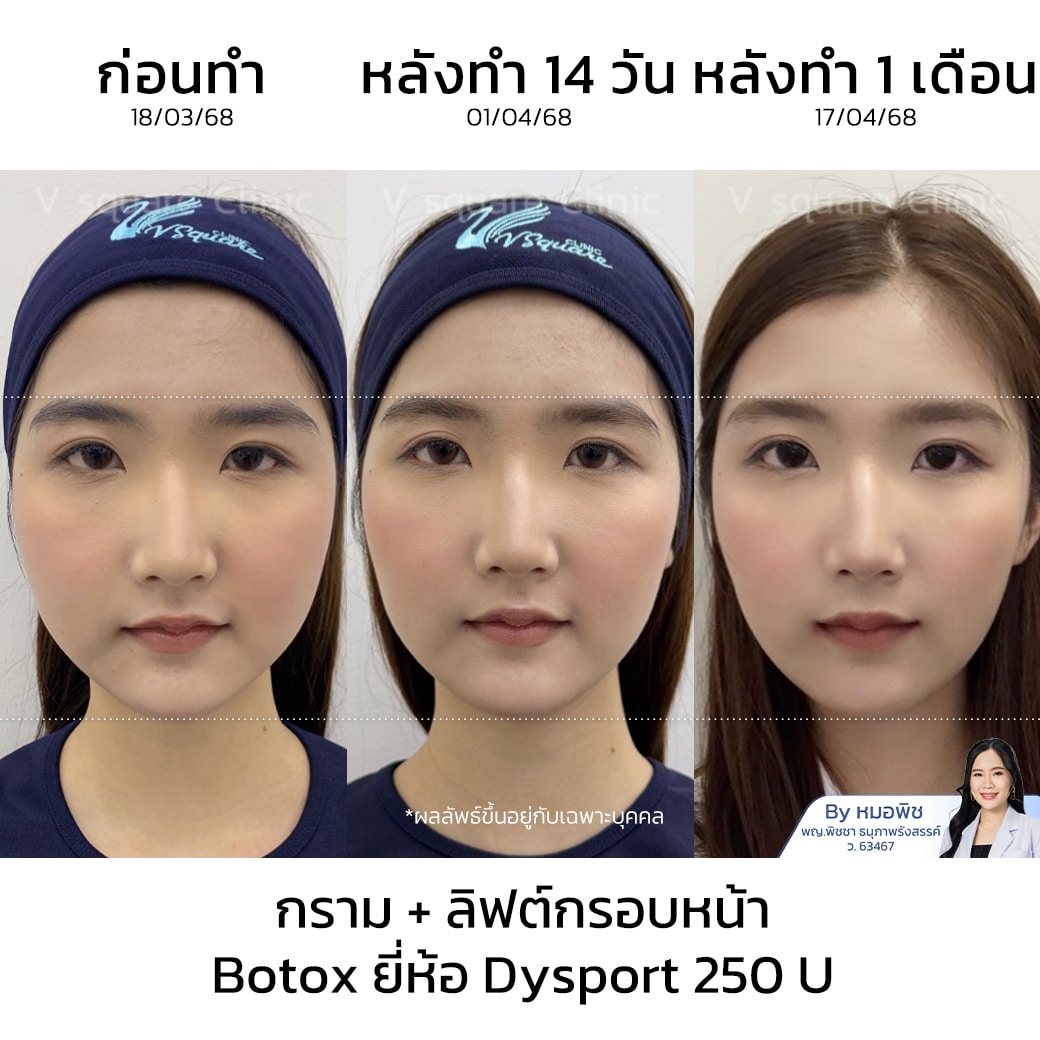 รีวิวโบท็อกกรามและลิฟกรอบหน้า_คุณคาโอริ