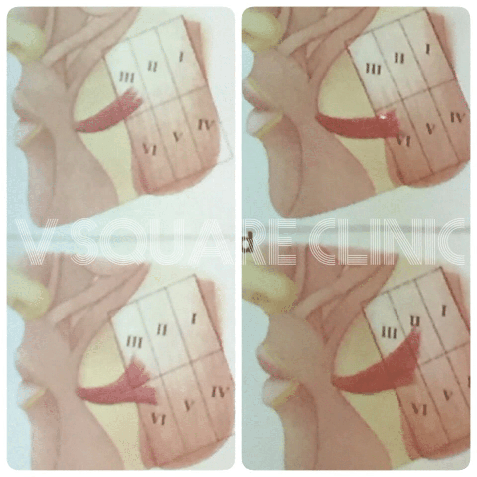 โบท็อกลดกราม ยิ้มแข็ง