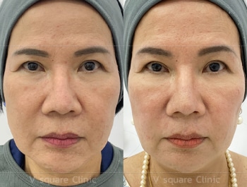 รีวิว Thermage ทั่วหน้า 900 Line + Thermage ตา 450 Line