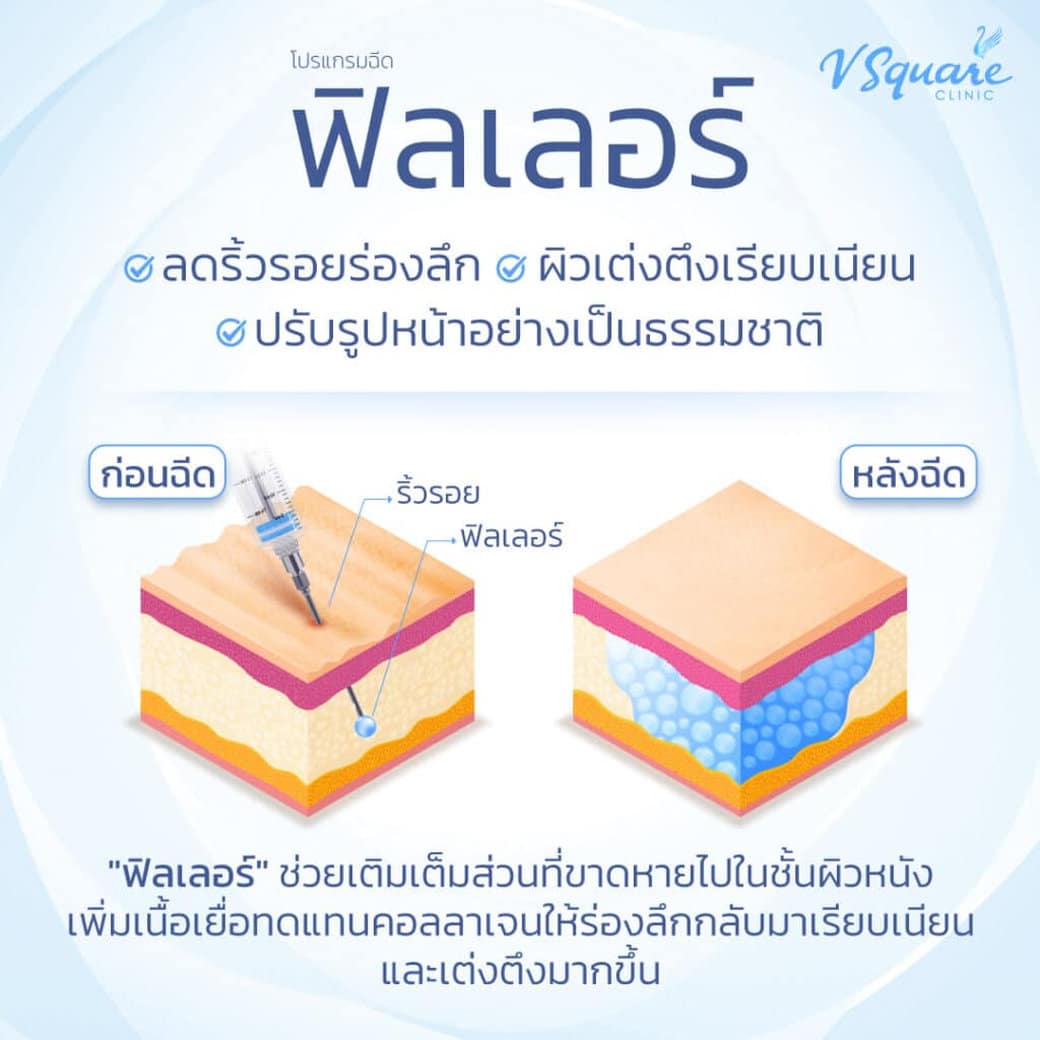 ฟิลเลอร์ Skin Booster