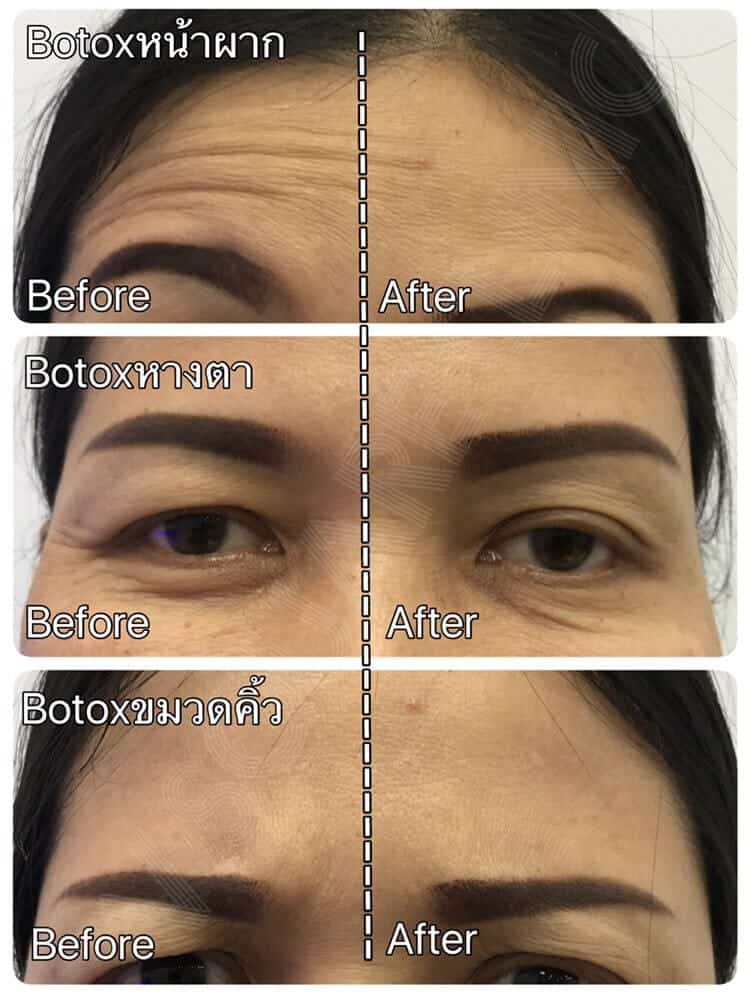 รีวิว Botox หางตา