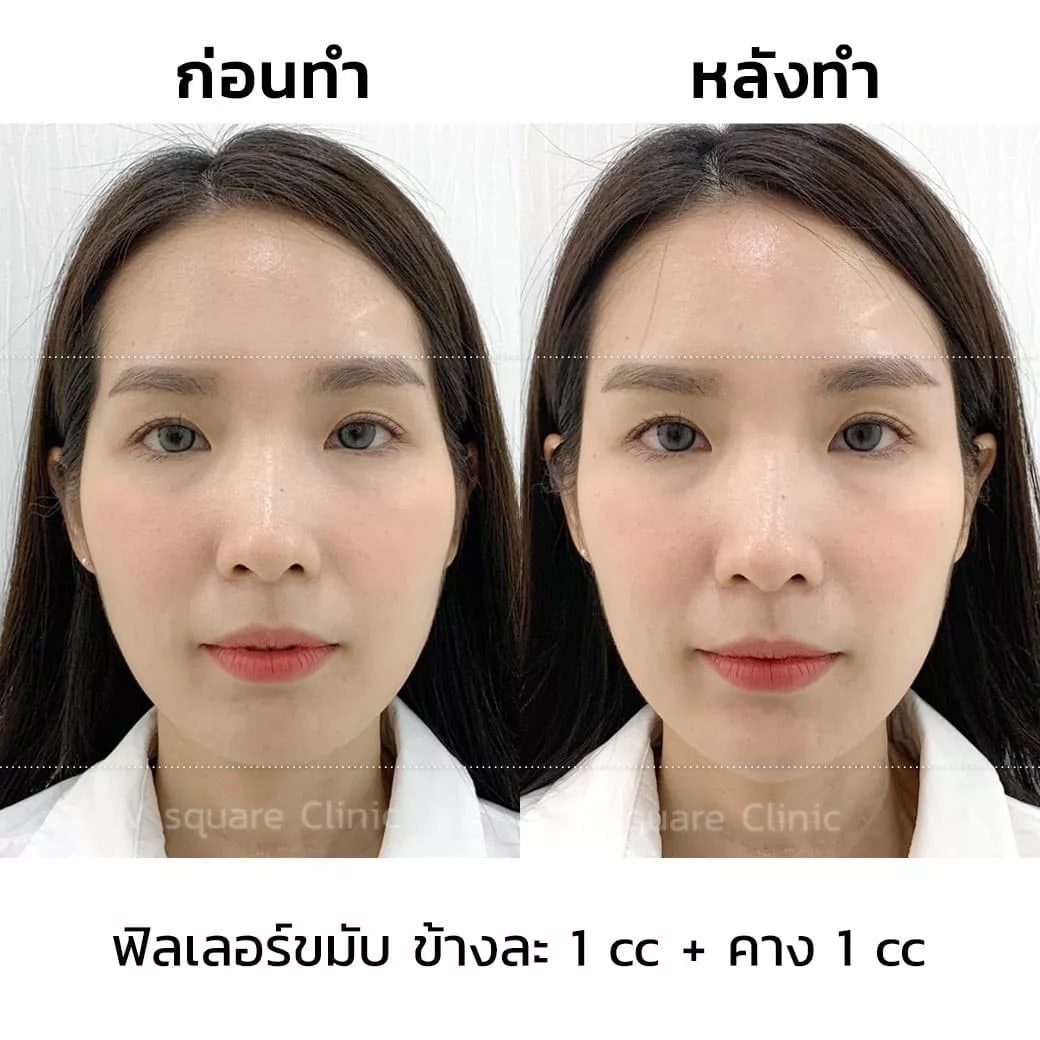 รีวิว ฉีดฟิลเลอร์ขมับ คาง จุดละ 1 CC_พิน