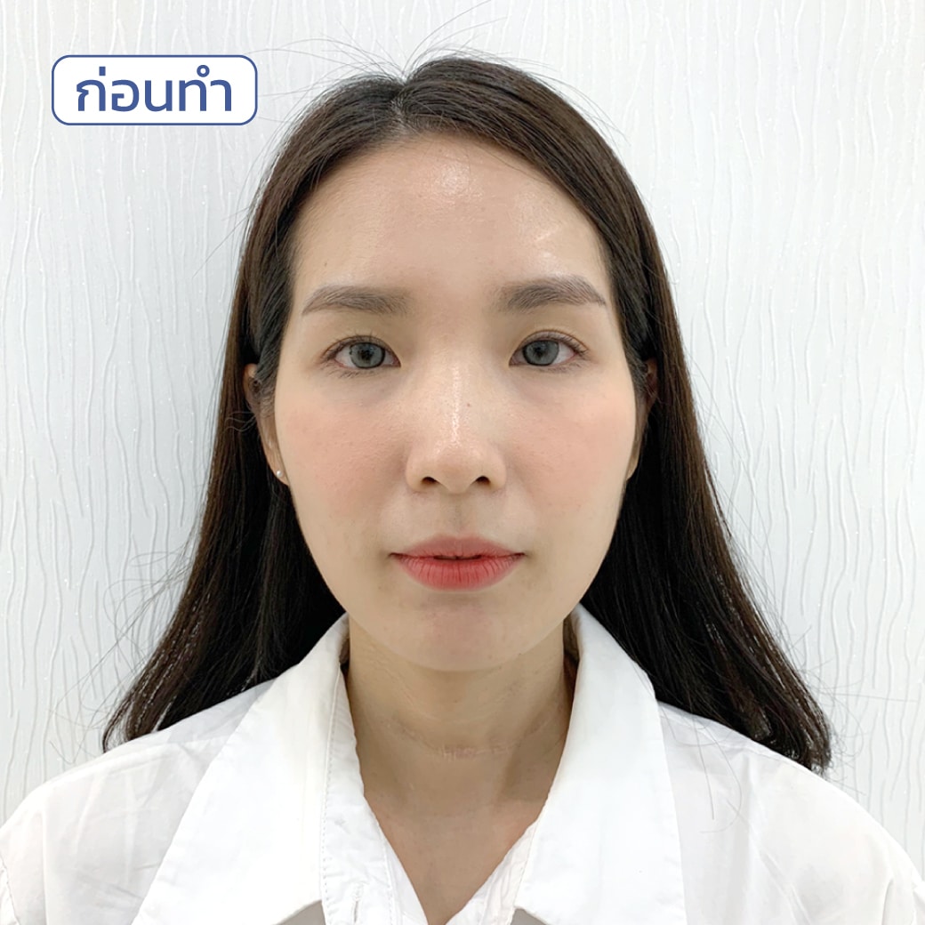 รีวิว ฟิลเลอร์ขมับ แก้ปัญหาขมับตอบ(1)