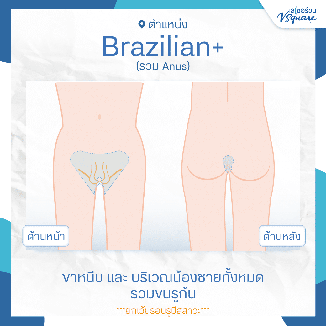 เลเซอร์บิกินี่ผู้ชาย