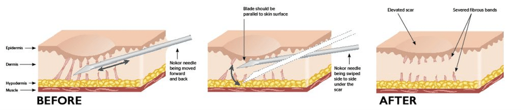 Subcision