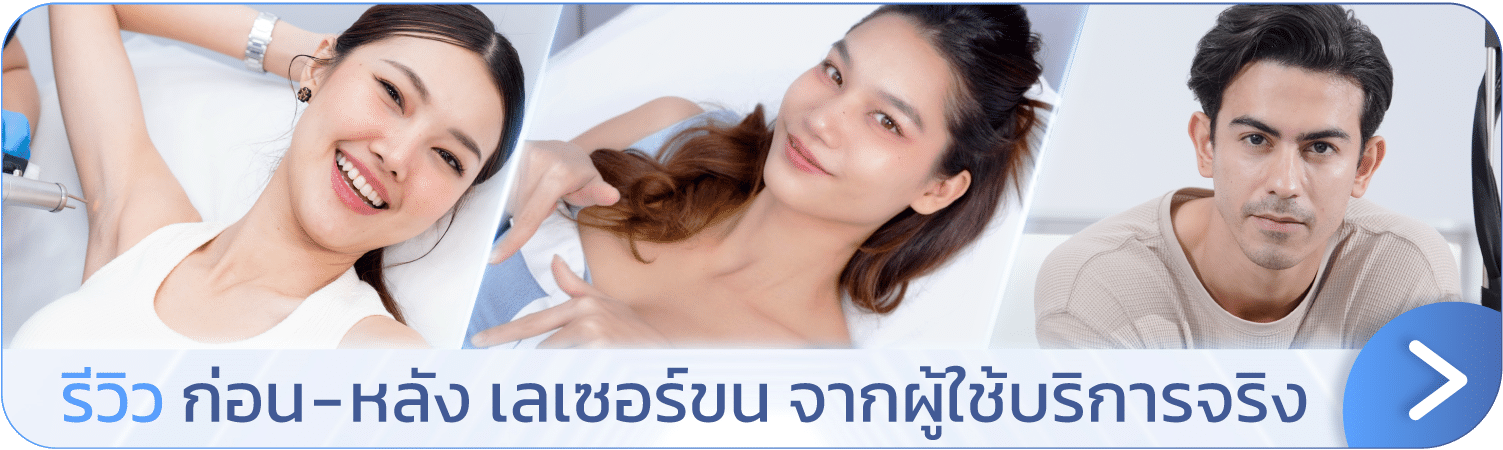 รีวิวเลเซอร์ขนหน้า
