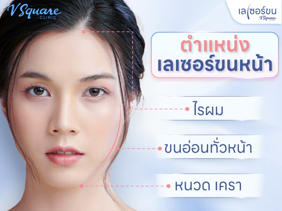 ตำแหน่งเลเซอร์ขนหน้า