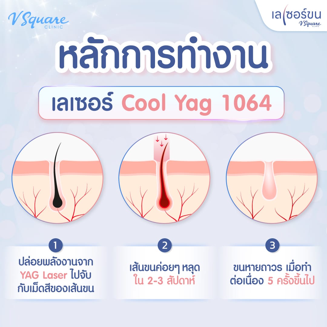 หลักการทำงานเลเซอร์ขน