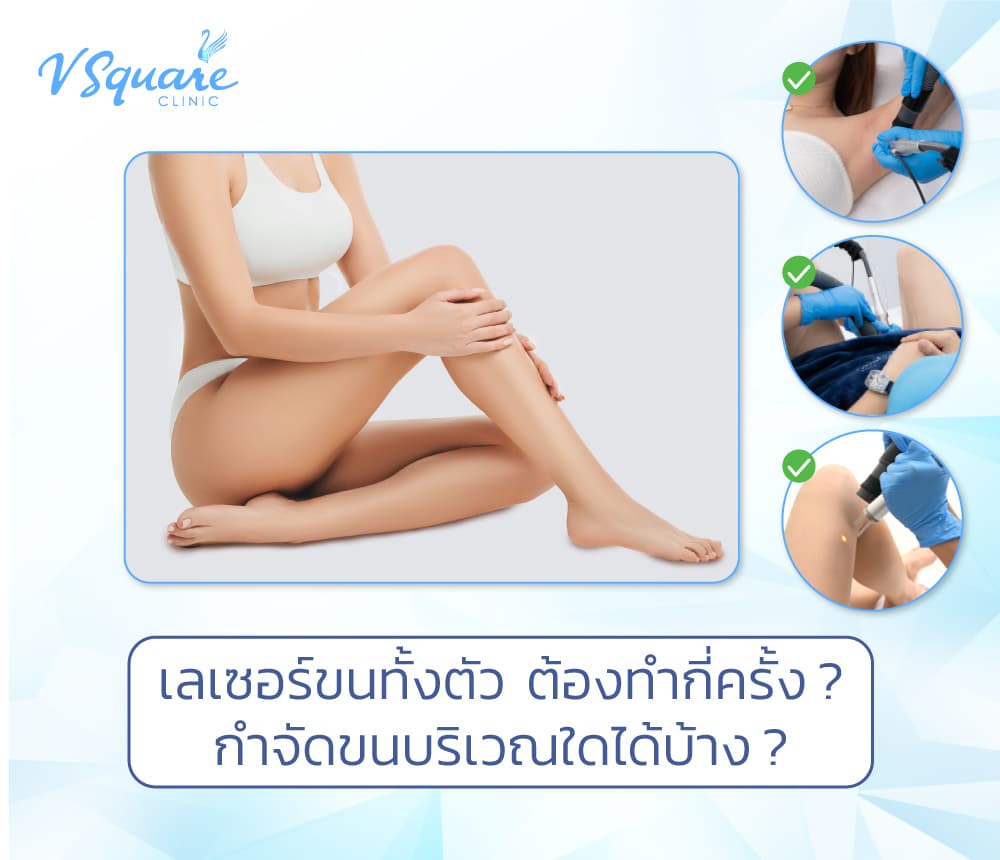 เลเซอร์ขนทั้งตัว
