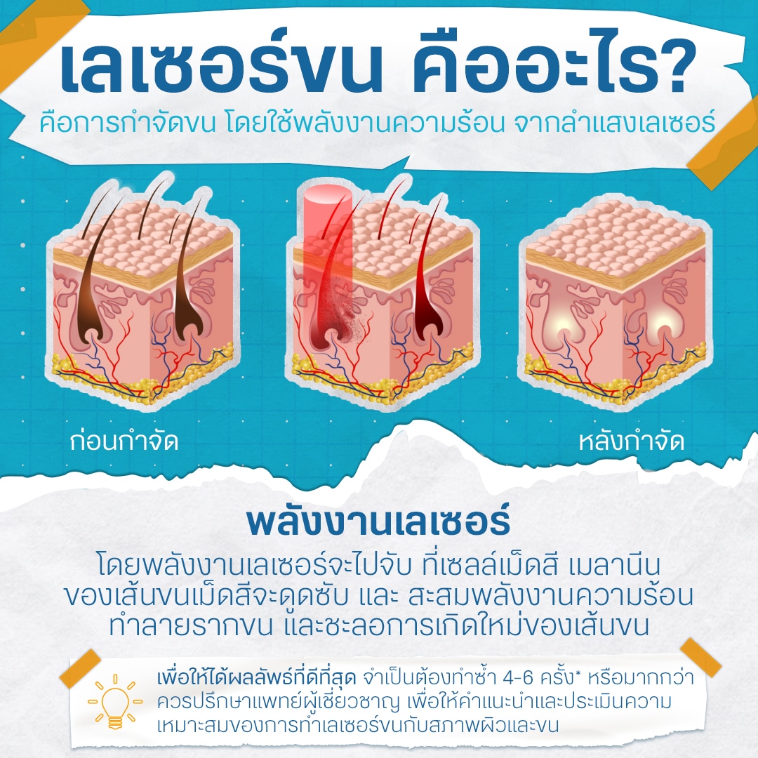 เลเซอร์ขนทั้งตัวคืออะไร