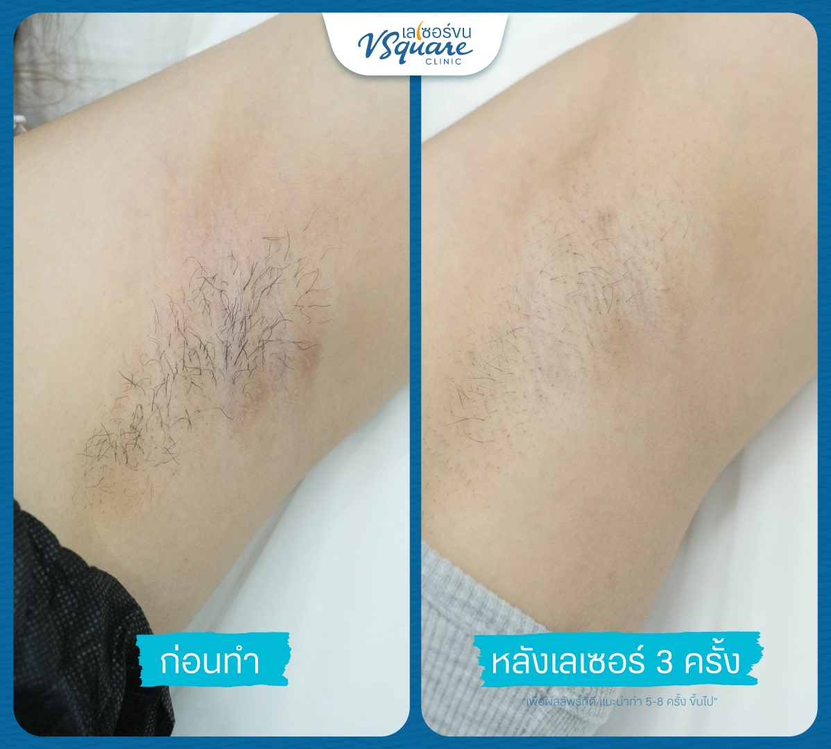 เลเซอร์ขนรักแร้ รีวิว