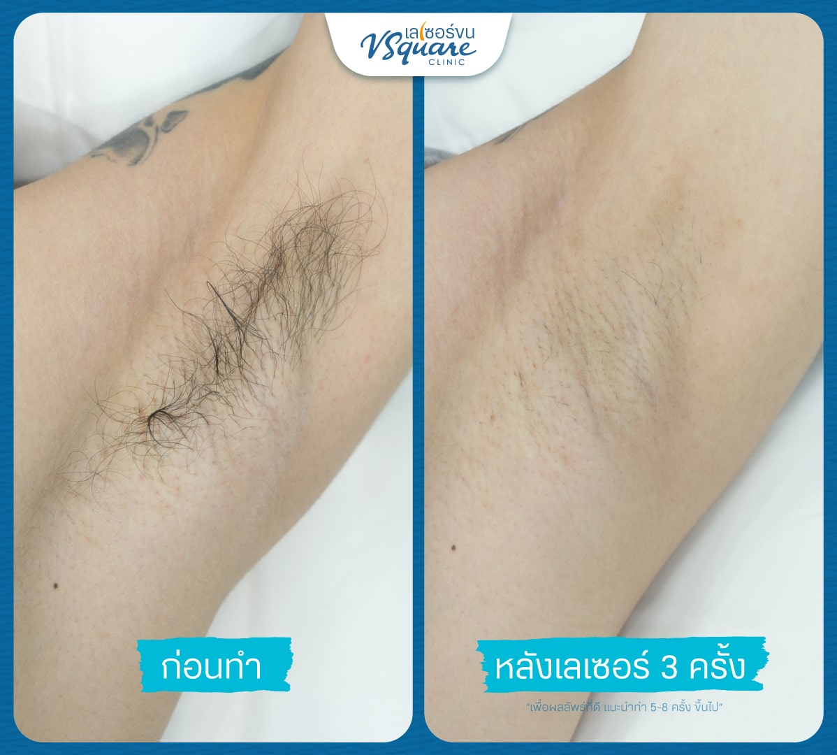 เลเซอร์ขนรักแร้ รีวิว(2)