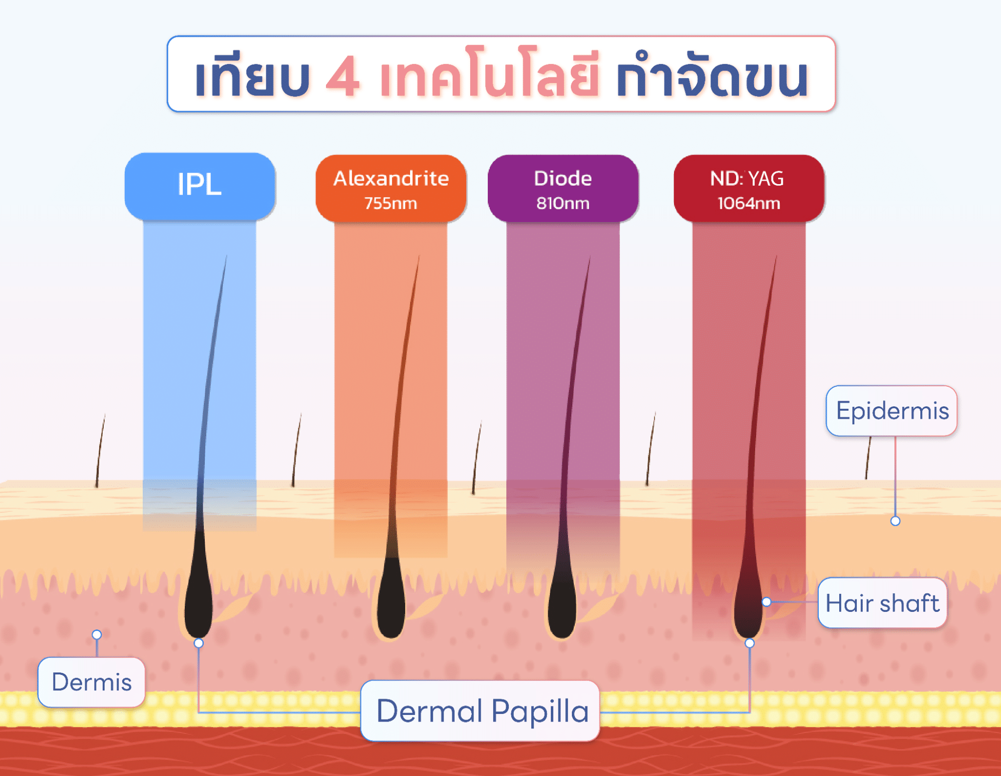 เลเซอร์ขนรักแร้มีกี่แบบ
