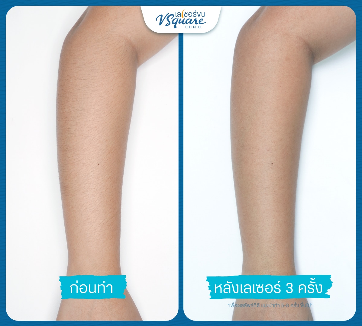 เลเซอร์ขนแขน รีวิว(1)