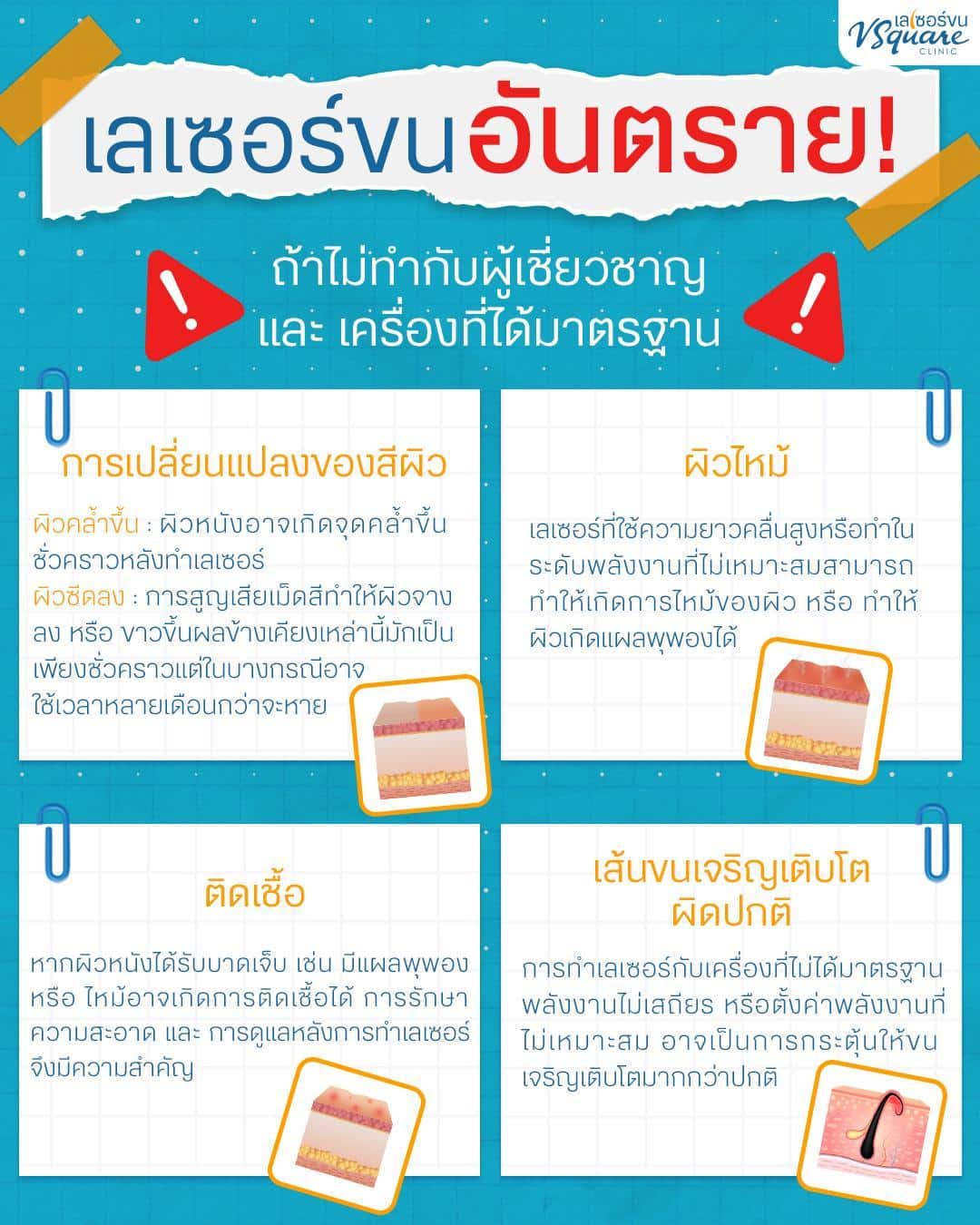 เลเซอร์แคม อันตรายไหม