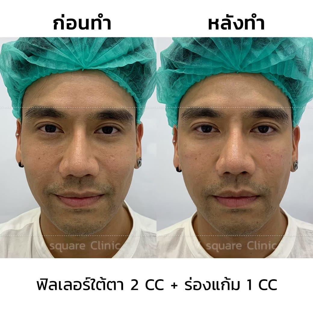 รีวิวฉีดฟิลเลอร์ร่องแก้ม 1 CC ที่  V Square Clinic พีท