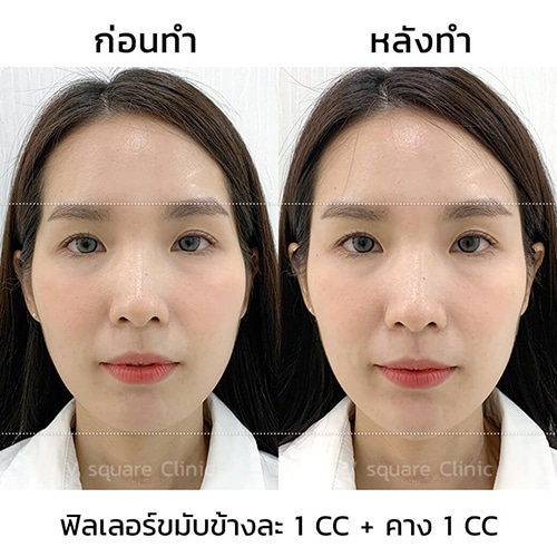 รีวิวฉีดฟิลเลอร์คาง 1 CC ที่  V Square Clinic