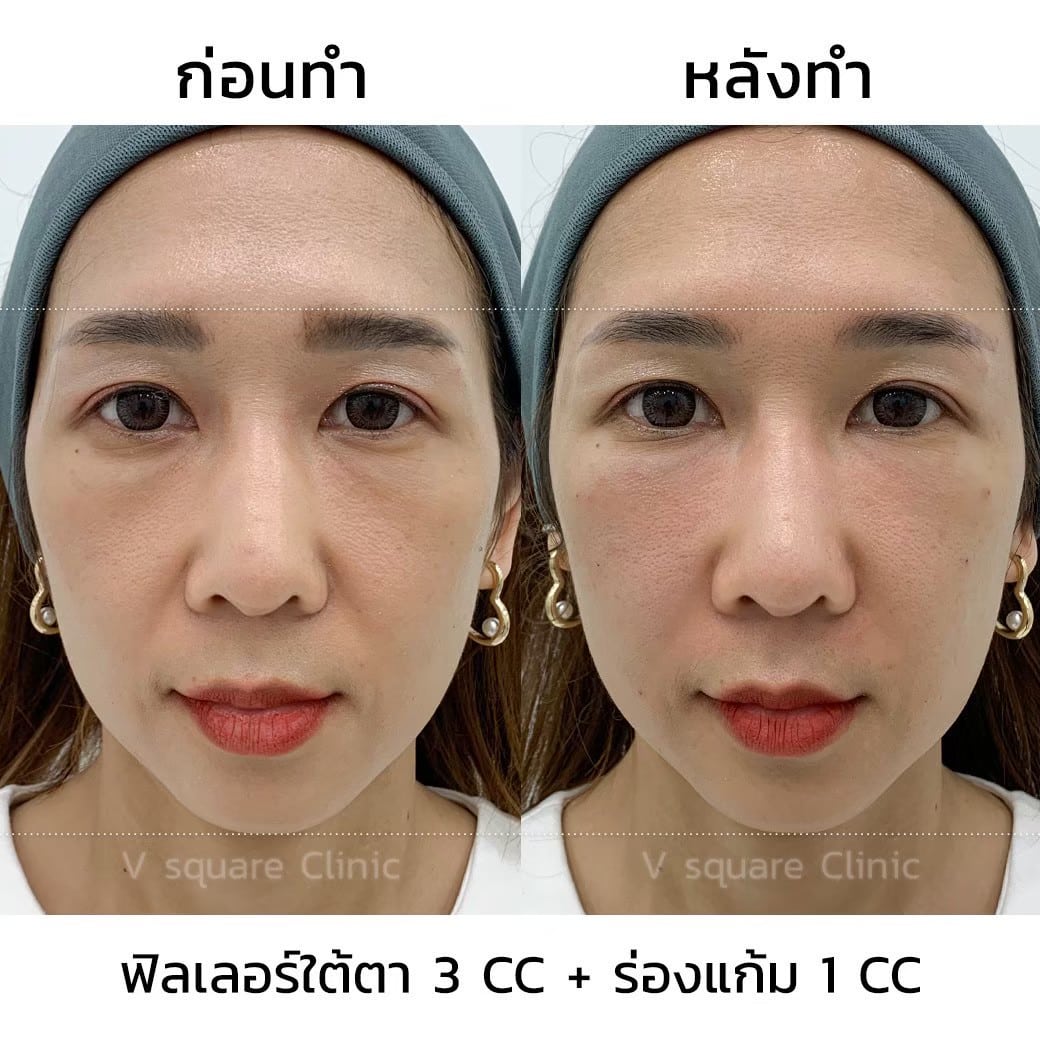 รีวิวฉีดฟิลเลอร์ร่องแก้ม 1 CC ที่  V Square Clinic