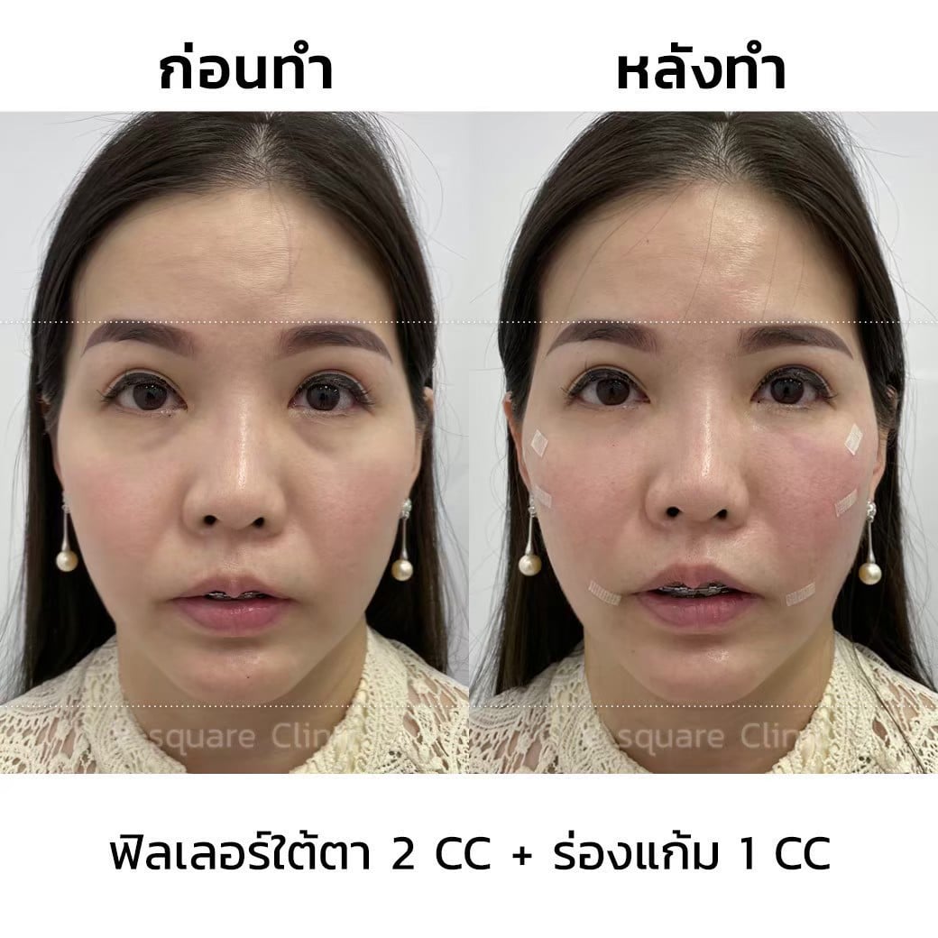 รีวิวฉีดฟิลเลอร์ร่องแก้ม 1 CC ที่  V Square Clinic