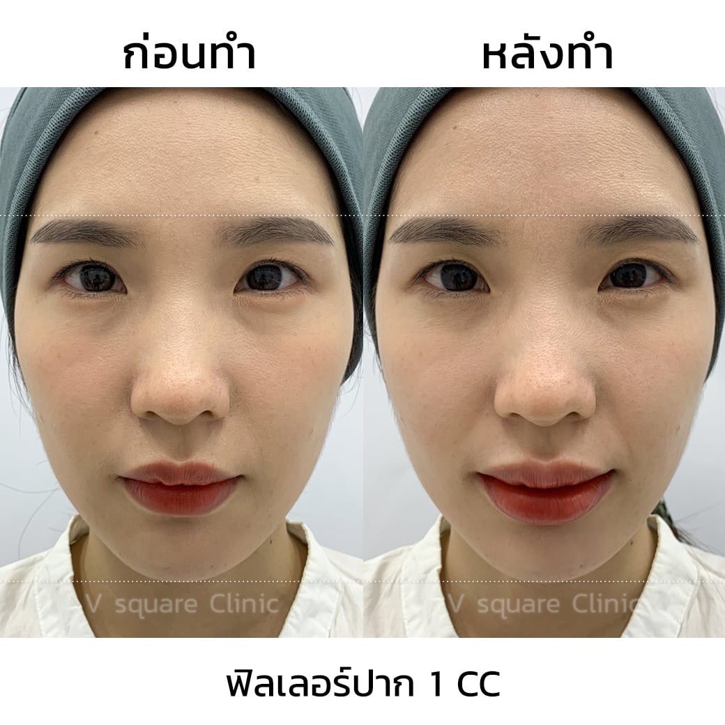 รีวิวฉีดฟิลเลอร์ปาก 1 CC ที่  V Square Clinic