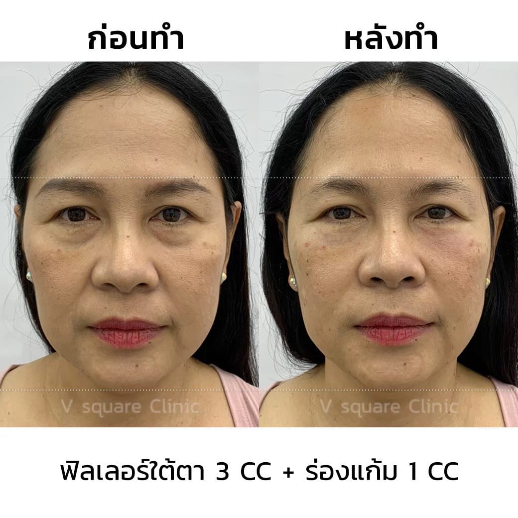 รีวิวฉีดฟิลเลอร์ร่องแก้ม 1 CC ที่  V Square Clinic
