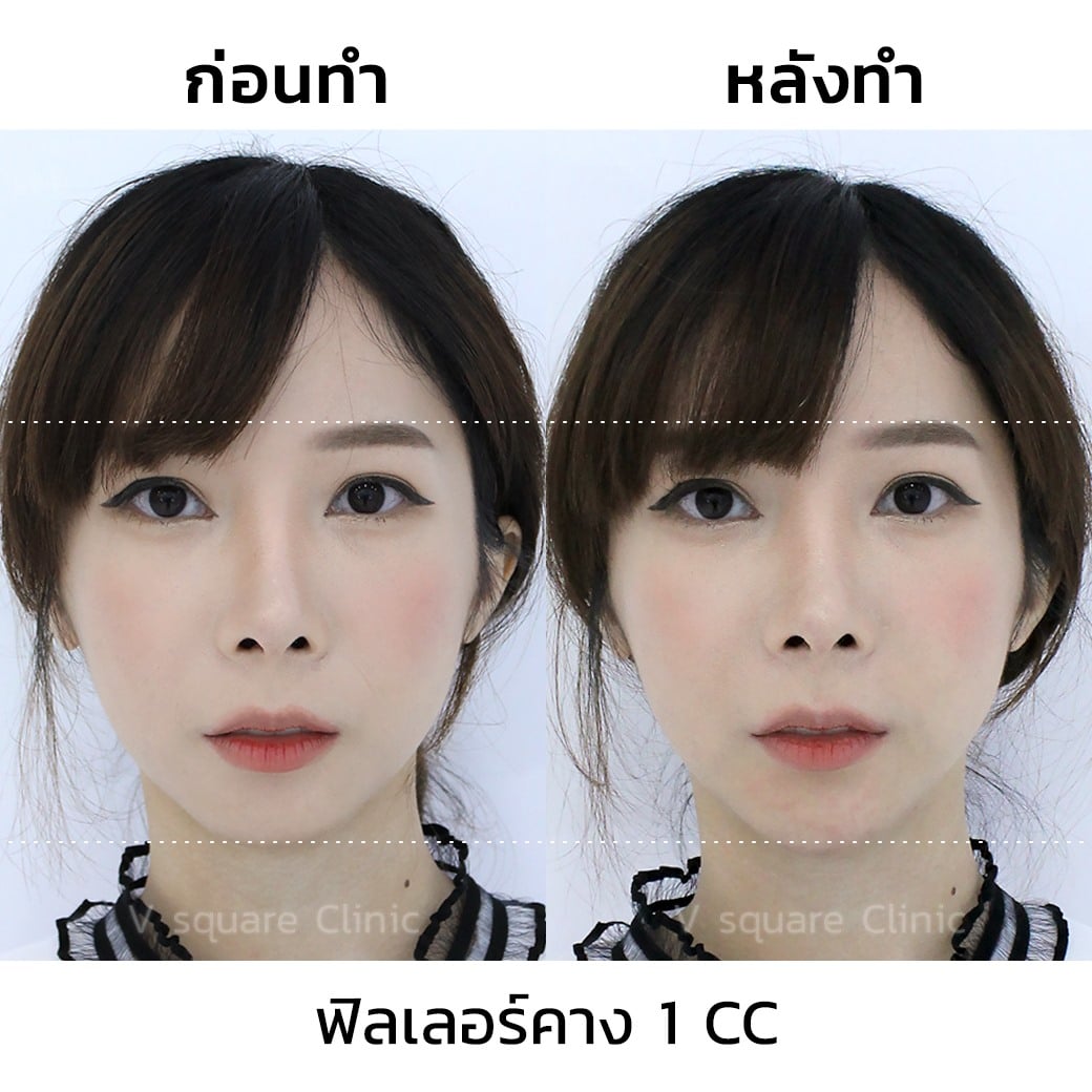 รีวิวฉีดฟิลเลอร์คาง 1 CC ที่  V Square Clinic