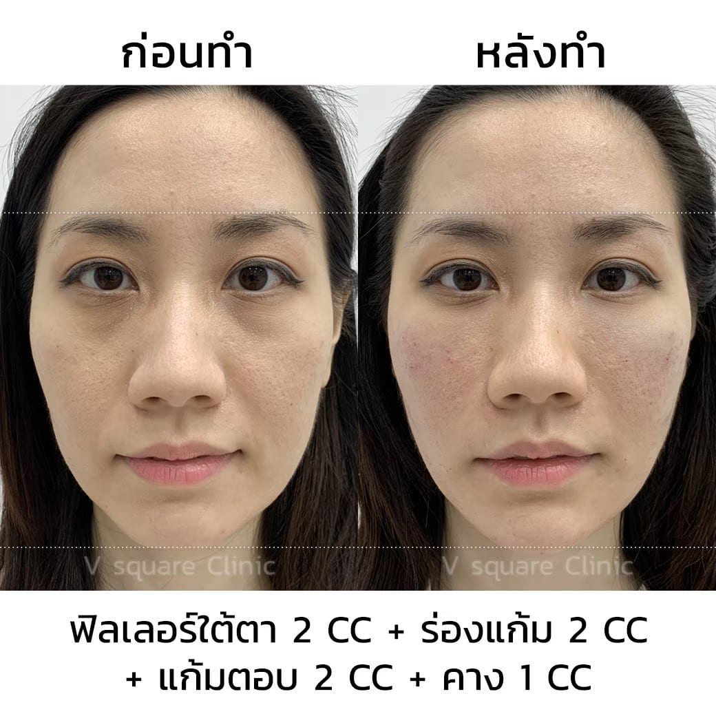 รีวิวฉีดฟิลเลอร์คาง 1 CC ที่  V Square Clinic