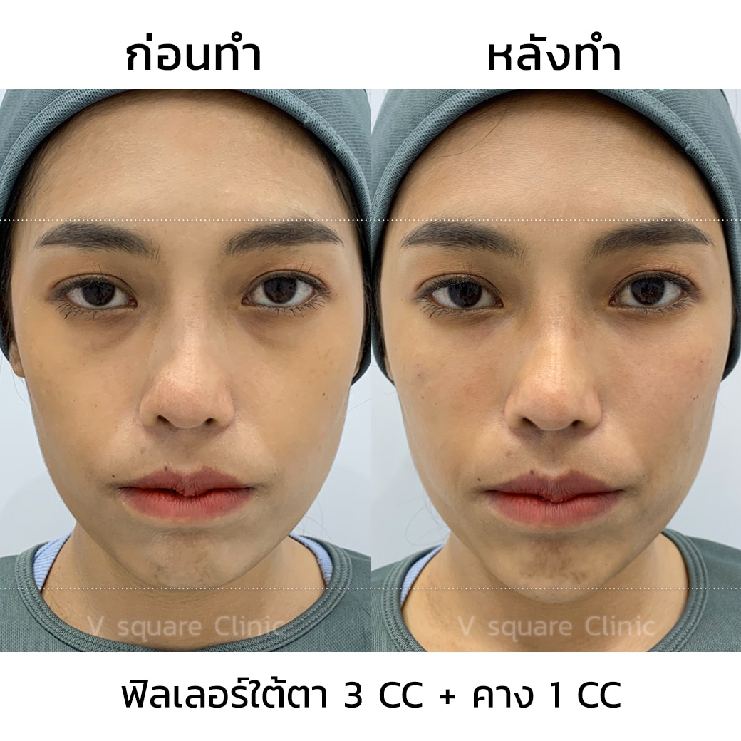 รีวิวฉีดฟิลเลอร์คาง 1 CC ที่  V Square Clinic
