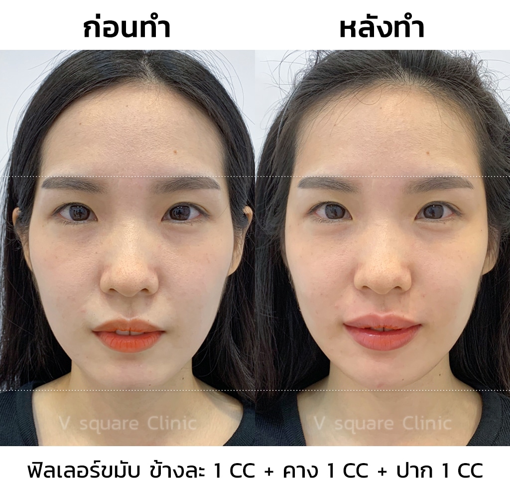 รีวิวฉีดฟิลเลอร์คาง 1 CC ที่  V Square Clinic