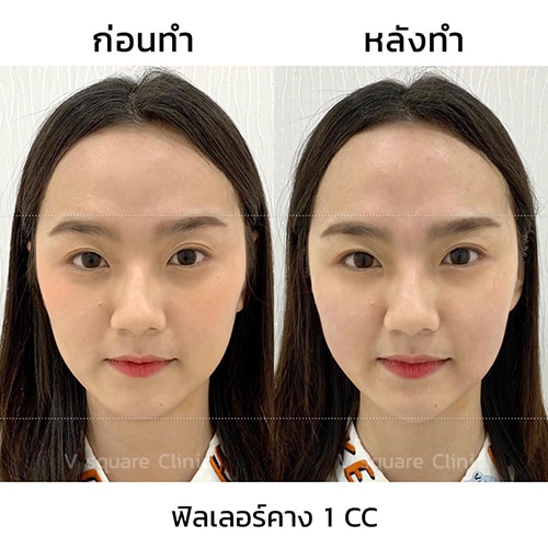 รีวิวฉีดฟิลเลอร์คาง 1 CC ที่  V Square Clinic