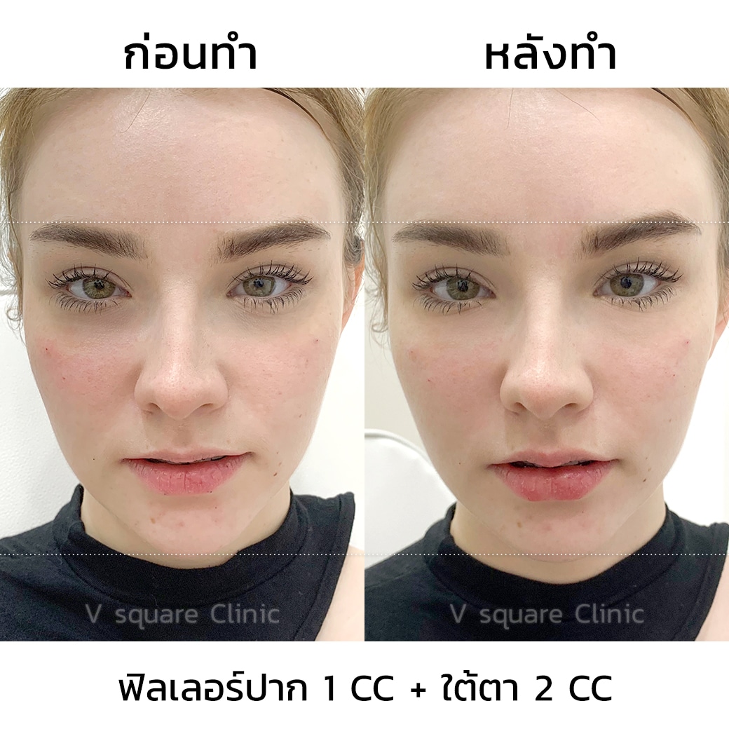 รีวิวฉีดฟิลเลอร์ปาก 1 CC ที่  V Square Clinic เจสซี่