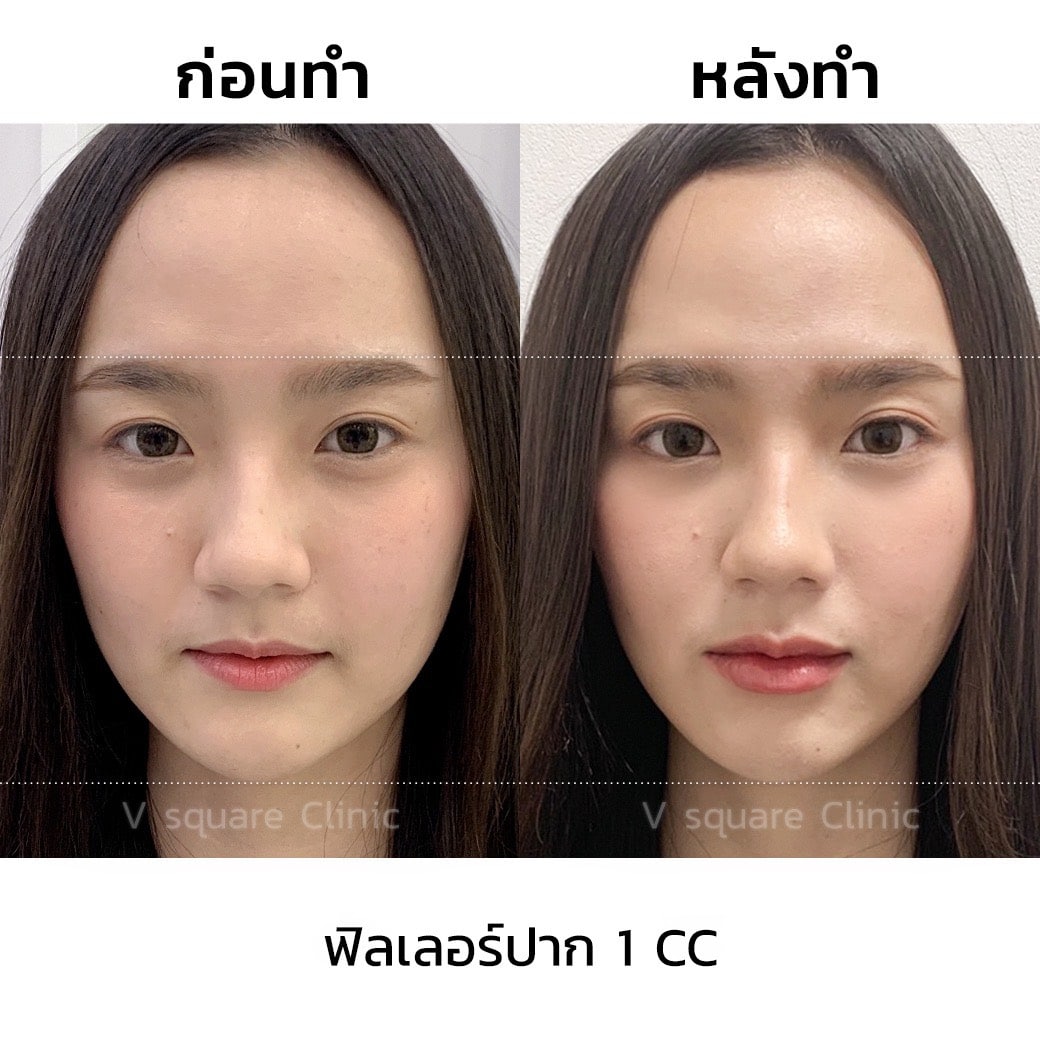 รีวิวฉีดฟิลเลอร์ปาก 1 CC ที่  V Square Clinic