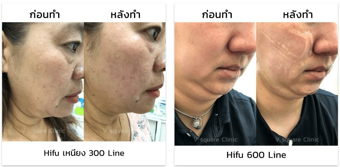 รีวิว Hifu เหนียง