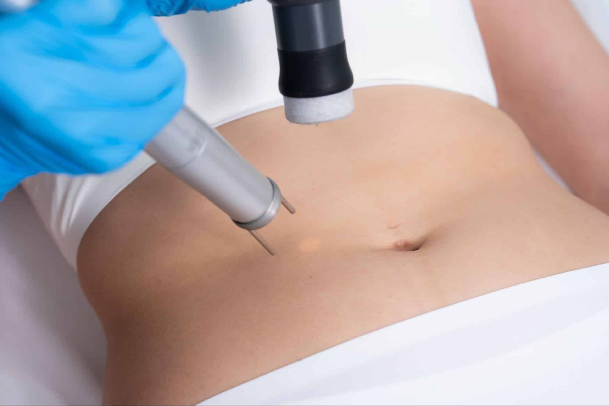 เลเซอร์ขนหน้าท้อง ดีไหม