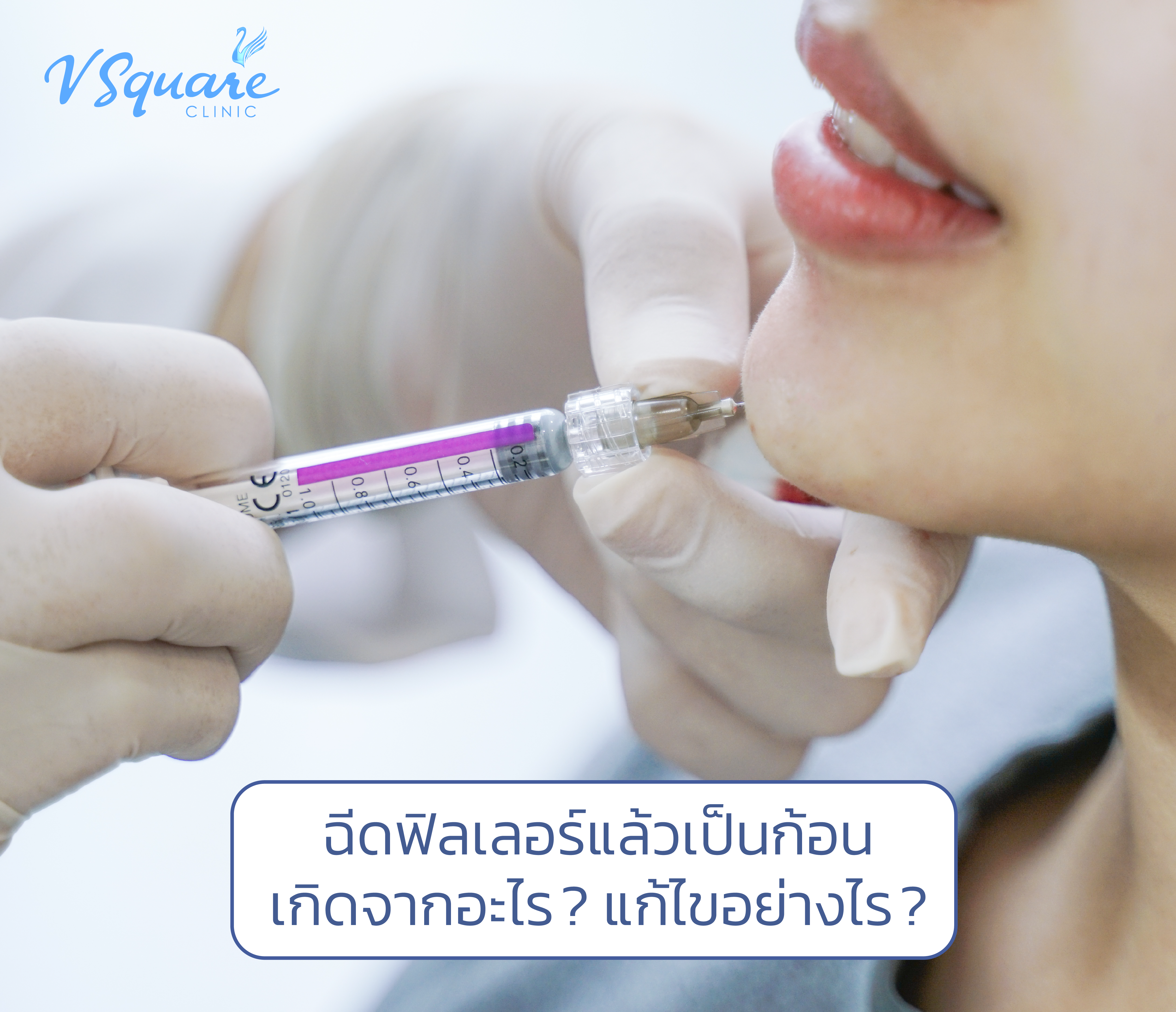 ฉีดฟิลเลอร์แล้วเป็นก้อน