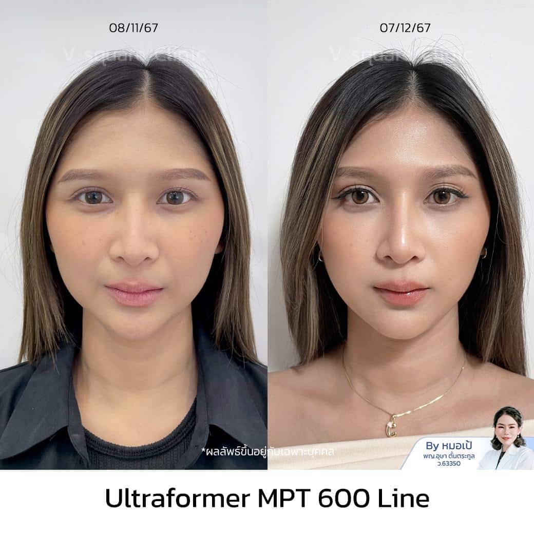 รีวิวผลลัพธ์ Ultraformer MPT_พี่ครีม