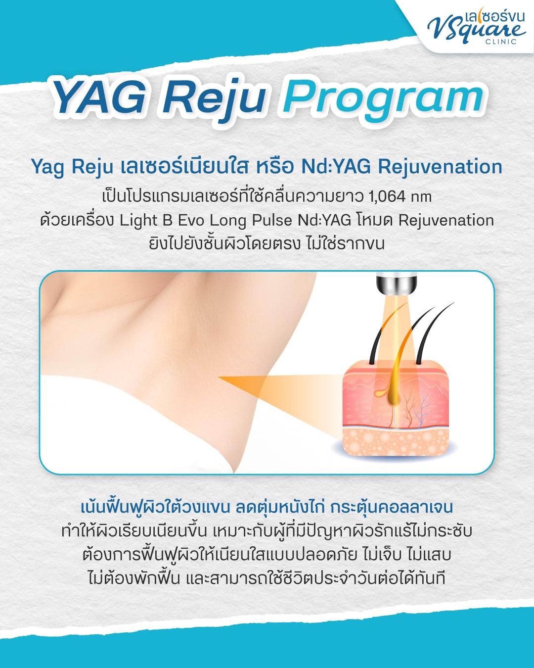 Yag Reju เลเซอร์เนียนใส คืออะไร