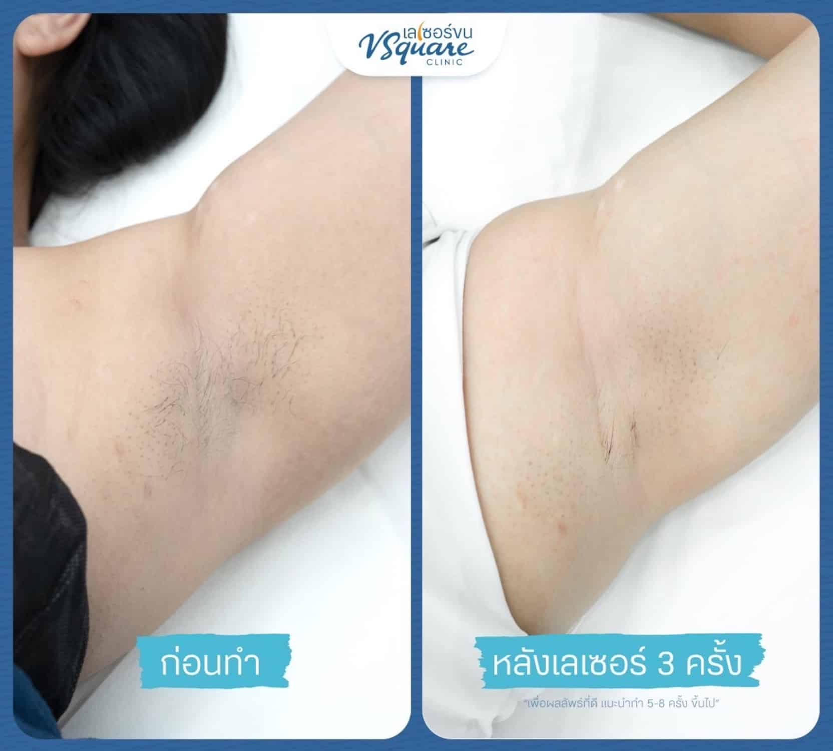 รีวิวเลเซอร์ขนรักแร้