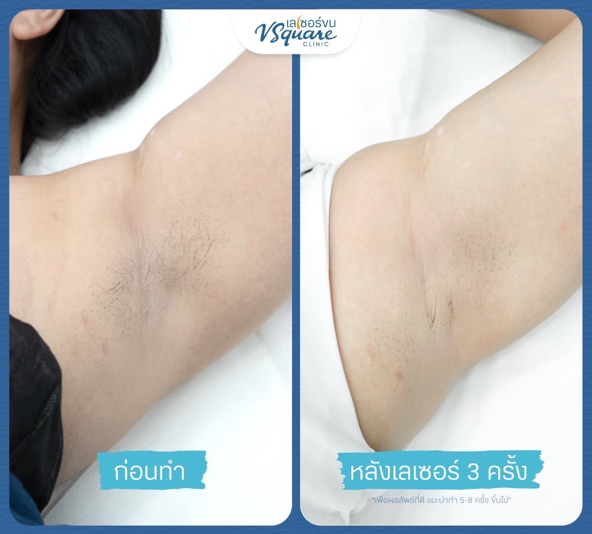 รีวิวเลเซอร์ขนรักแร้